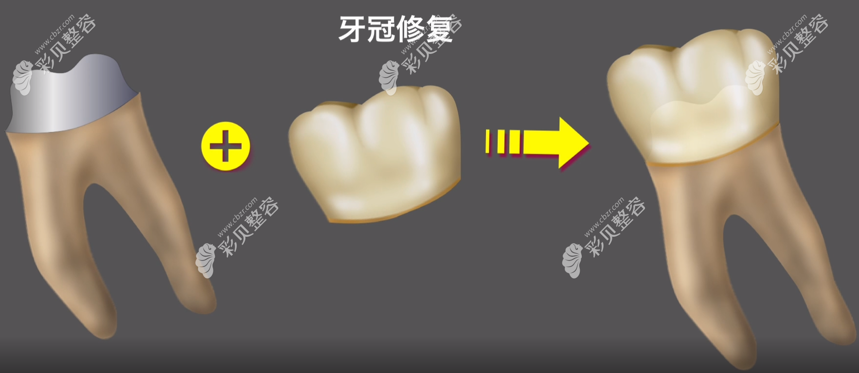 嵌体补牙和牙冠补牙价格哪个贵