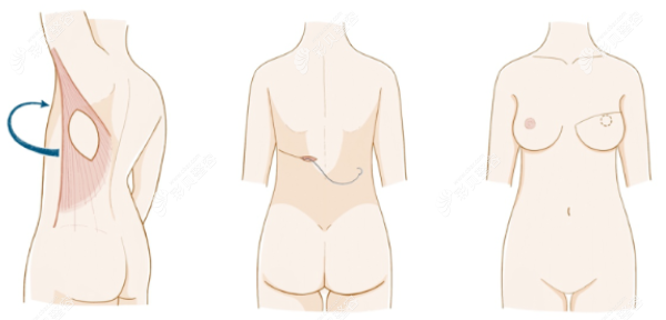 奥美定癌变后乳房切除重建手术过程