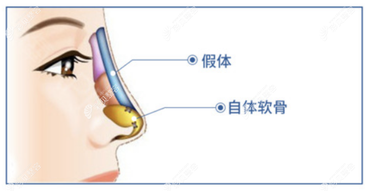 耳软骨鼻综合一般多少钱左右