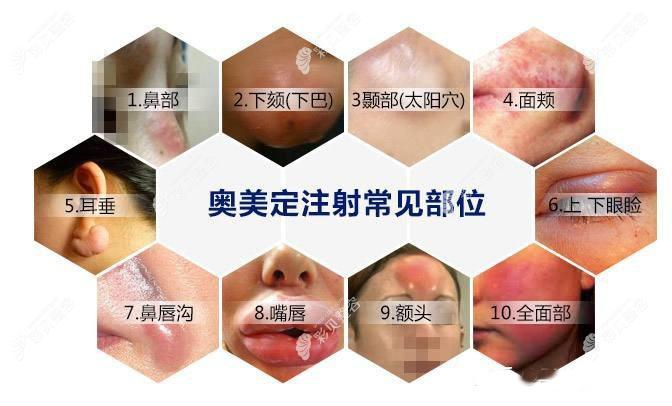 奥美定常见注射部位有哪些