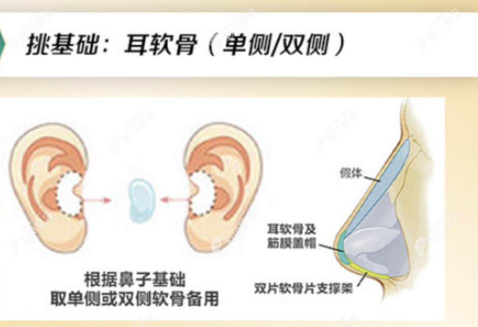 耳软骨隆鼻能维持几年被吸收www.cbzr.com