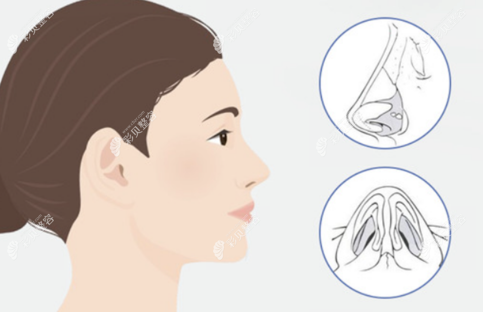耳软骨鼻综合修复可以只修复鼻头吗