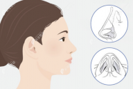 耳软骨鼻综合修复可以只修复鼻头吗，鼻假体还能继续用吗