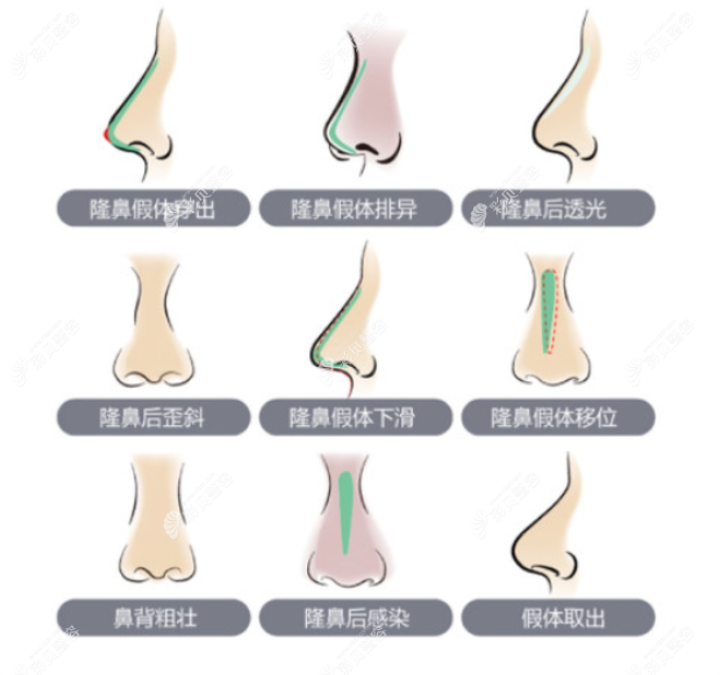 隆鼻失败症状图片