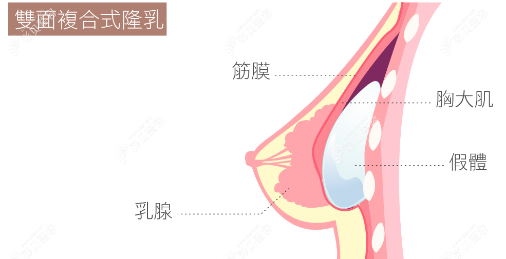 复合隆胸和假体隆胸哪个好?对比手感和价格发现二者区别大