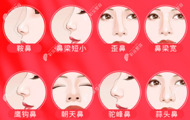 杨水斌医生做鼻子好吗?得看杨水斌个人资料,隆鼻技术和价格