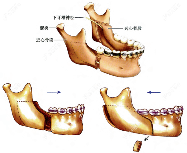 双侧下颌升支矢状劈开术正颌手术过程