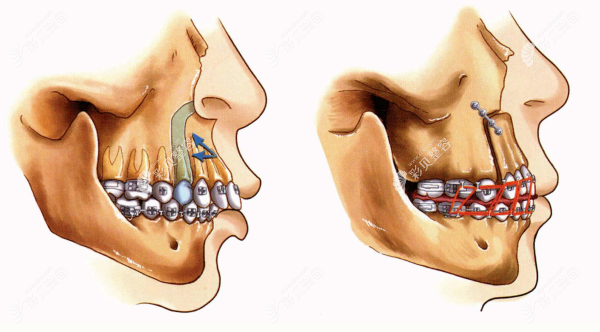 上颌前部截骨术操作过程 彩￥贝网