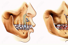正颌手术是怎么做的?为何正颌手术大多要做双颌而不是单颌