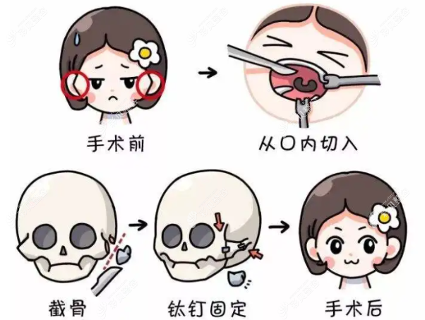 颧骨骨头高的人做一针降颧骨没有用 颧骨骨头高的人做一针降颧骨没有用