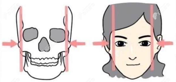 一针降颧骨真实经历分享 cbzr.com 一针降颧骨真实经历分享 cbzr.com