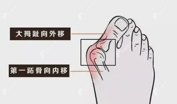 微创大脚骨手术会复发吗