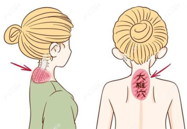 土麦森吸脂可以做富贵包,土麦森富贵包抽脂可靠价格还便宜