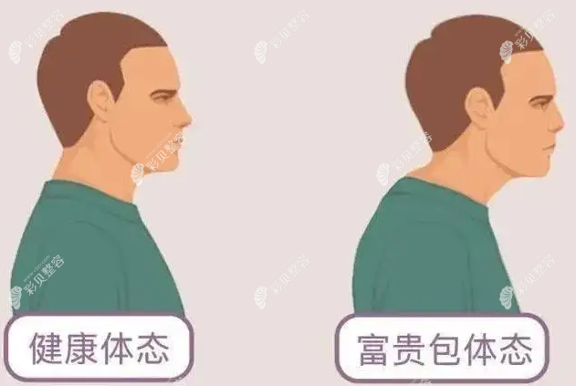 土麦森富贵包抽脂怎么样