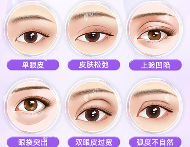 许言午医生做双眼皮怎么样 cbzr.com