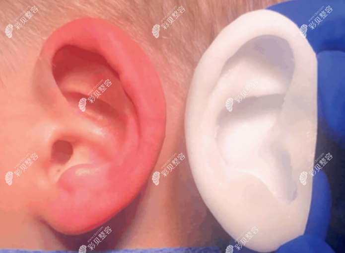 郑州生物支架耳再造手术多少钱