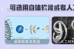 郑州耳朵再造术要多少钱?郑州耳再造手术价格7~10万左右