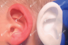 郑州耳朵再造术要多少钱?郑州耳再造手术价格7~10万左右