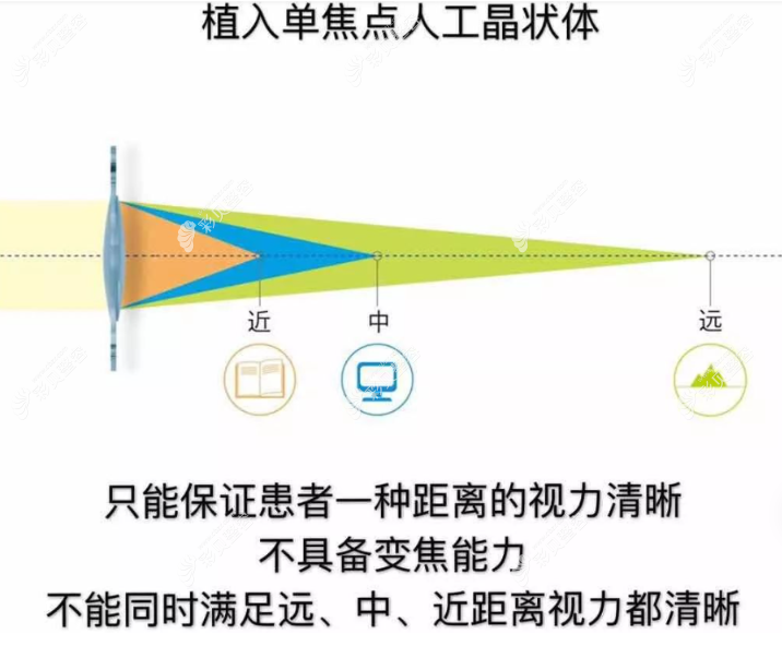爱尔康人工晶体sa60at和sn60at是单焦点晶体