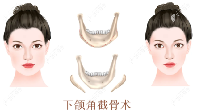 广州韩妃整形医院柳超医生磨骨手术怎么预约挂号