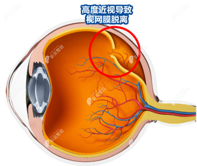视网膜脱离的主要原因是什么